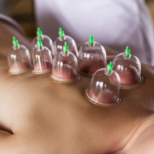 physiotherapy-center-cupping-evolution-physiotherapy-edmonton-ab