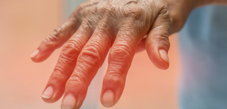 Arthritis-Can-Be-Exhausting