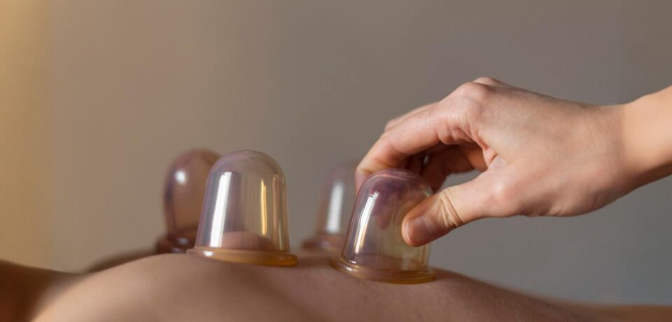 Cupping Therapy in Edmonton