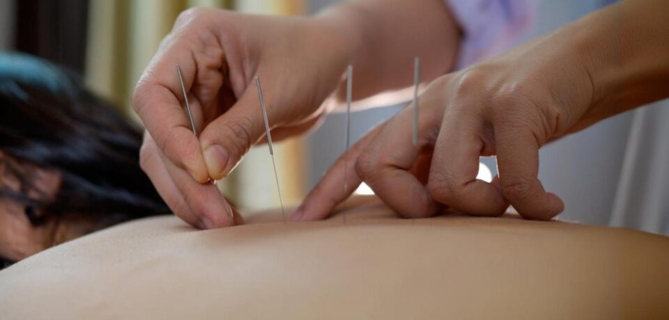 Dry needling