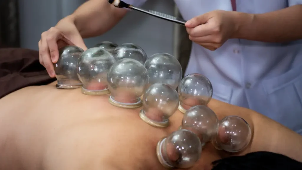 6 Ways Cupping Therapy Supports Athletic Recovery
