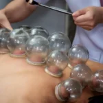 6 Ways Cupping Therapy Supports Athletic Recovery