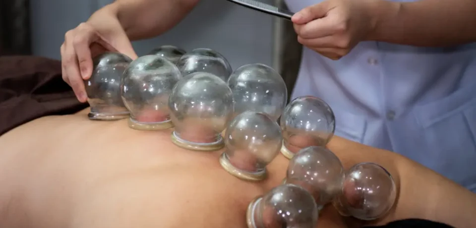 Cupping Therapy