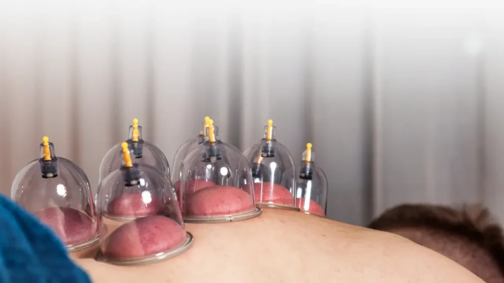 Cupping Therapy