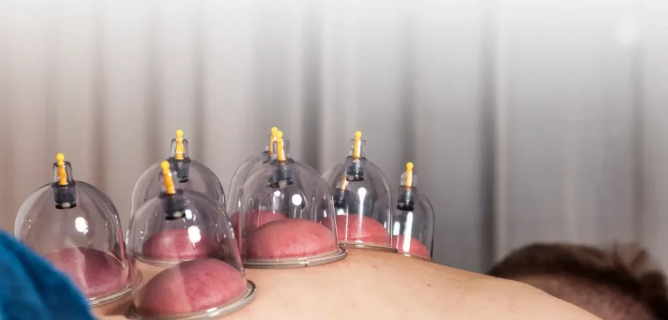 Cupping therapy Cupping Therapy