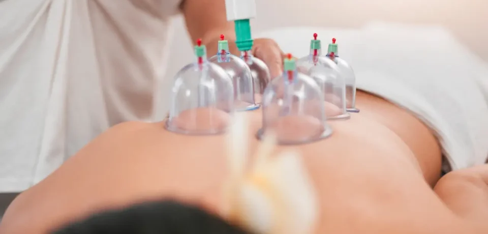 Cupping therapy session with glass cups placed on a patient's back for pain relief and wellness treatment.