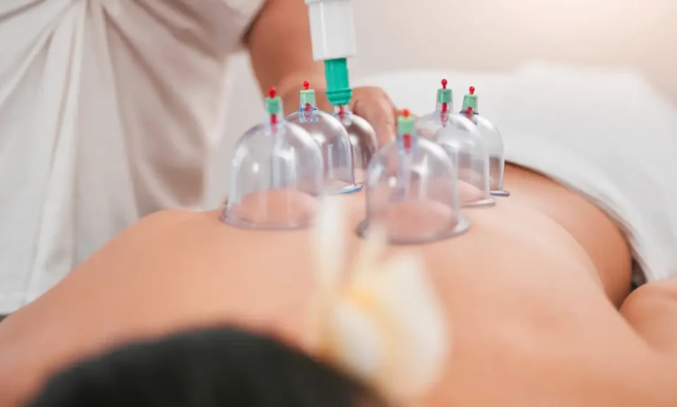 7 Signs Cupping Therapy May Support Muscle Recovery Cupping therapy session with glass cups placed on a patient's back for pain relief and wellness treatment.