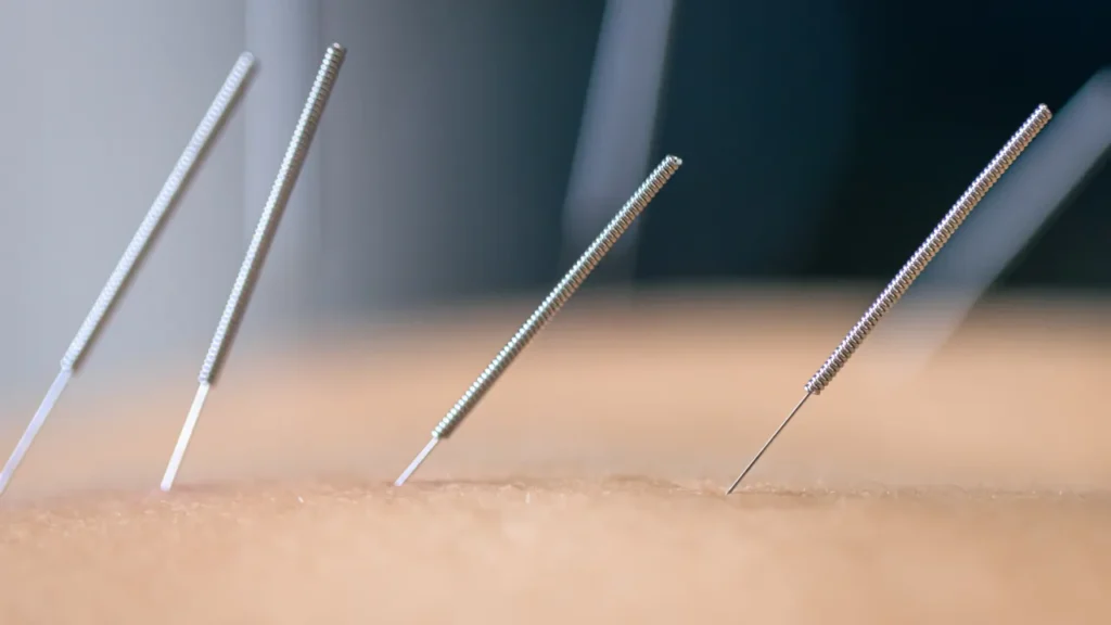 Dry Needling