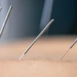 Dry Needling