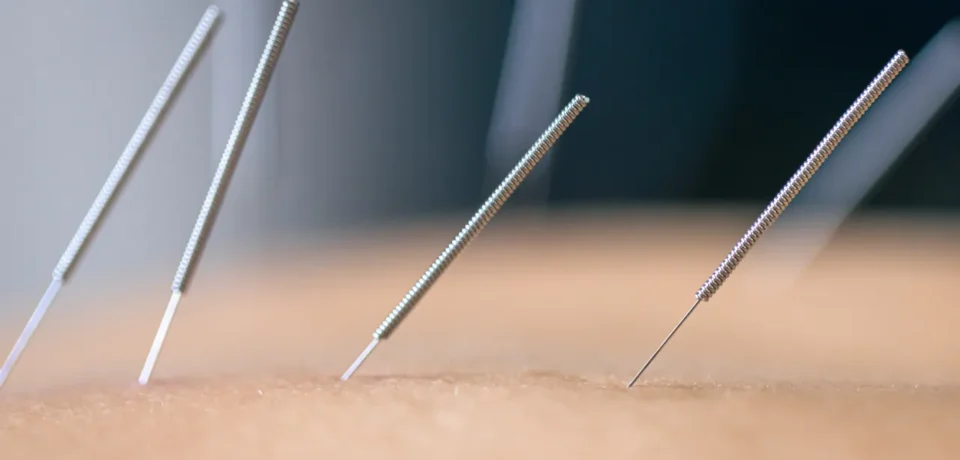 Dry Needling