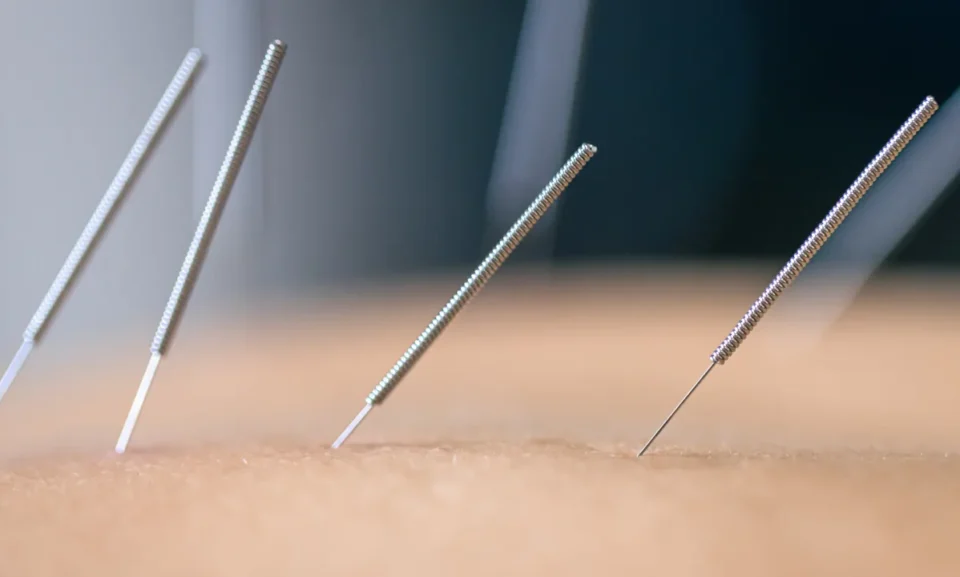 acupunture Dry Needling
