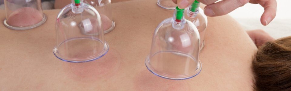 Cupping Therapy