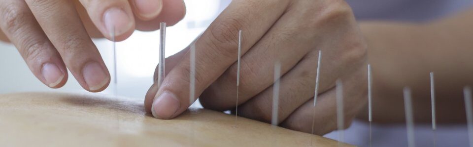 Dry Needling
